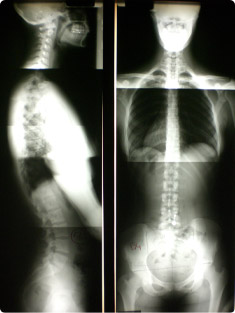 full spine x-rays